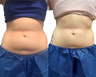CoolSculpting® Before & After Gallery - Patient 346075 - Image 1
