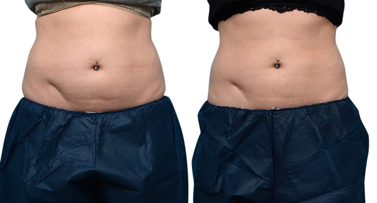 CoolSculpting® Before & After Gallery - Patient 406112 - Image 1