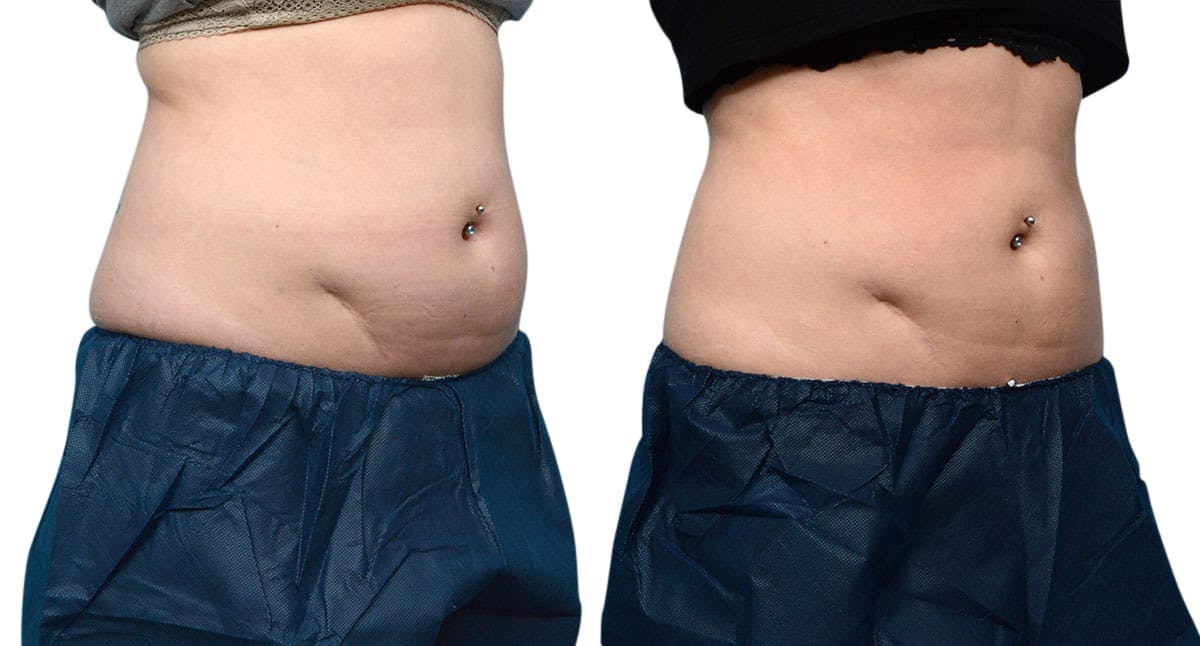 CoolSculpting® Before & After Gallery - Patient 406112 - Image 2