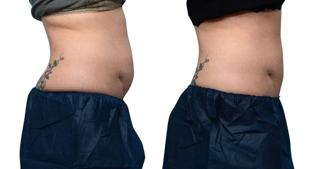 CoolSculpting® Before & After Gallery - Patient 406112 - Image 3