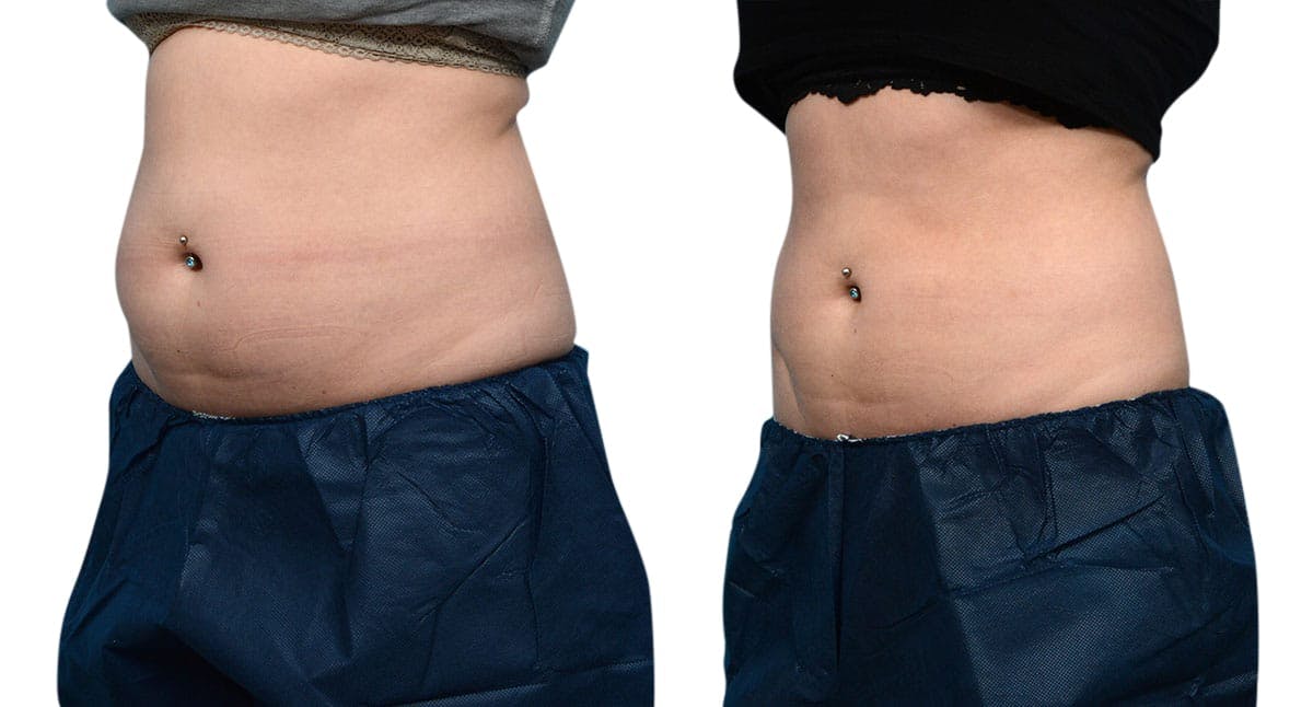CoolSculpting® Before & After Gallery - Patient 406112 - Image 4