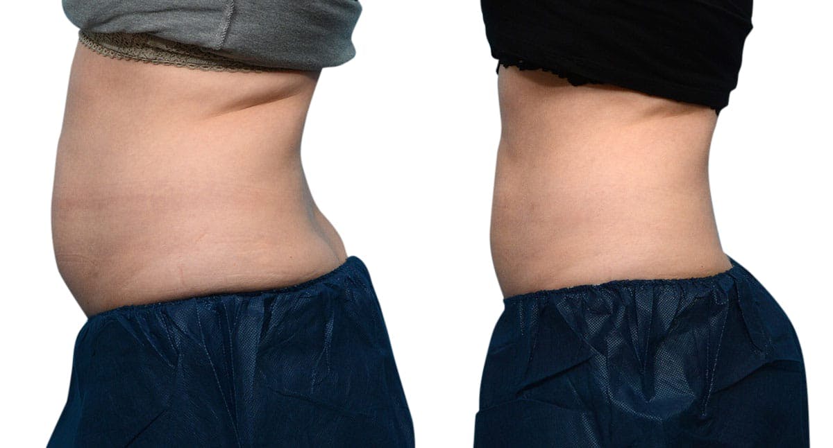 CoolSculpting® Before & After Gallery - Patient 406112 - Image 5