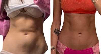 CoolSculpting® Before & After Gallery - Patient 361460 - Image 1