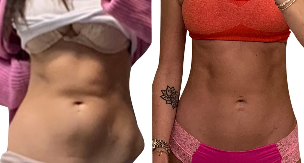 CoolSculpting® Before & After Gallery - Patient 361460 - Image 1