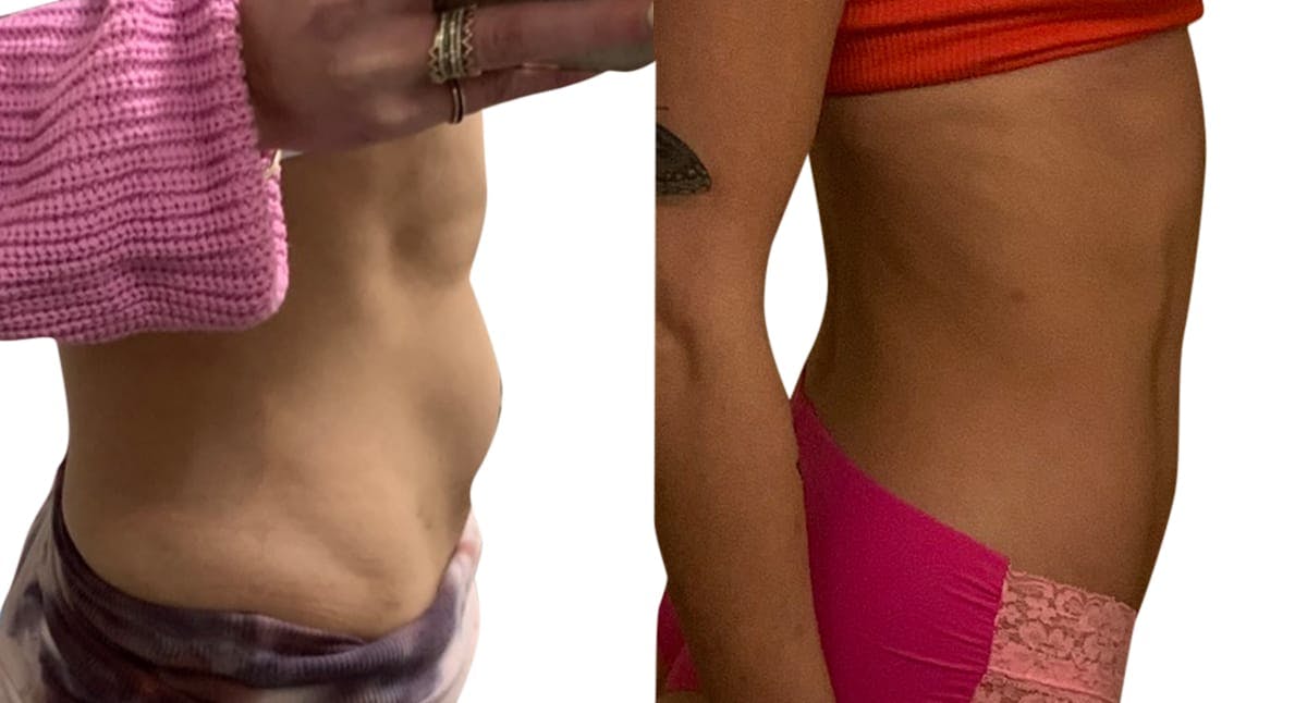 CoolSculpting® Before & After Gallery - Patient 361460 - Image 2