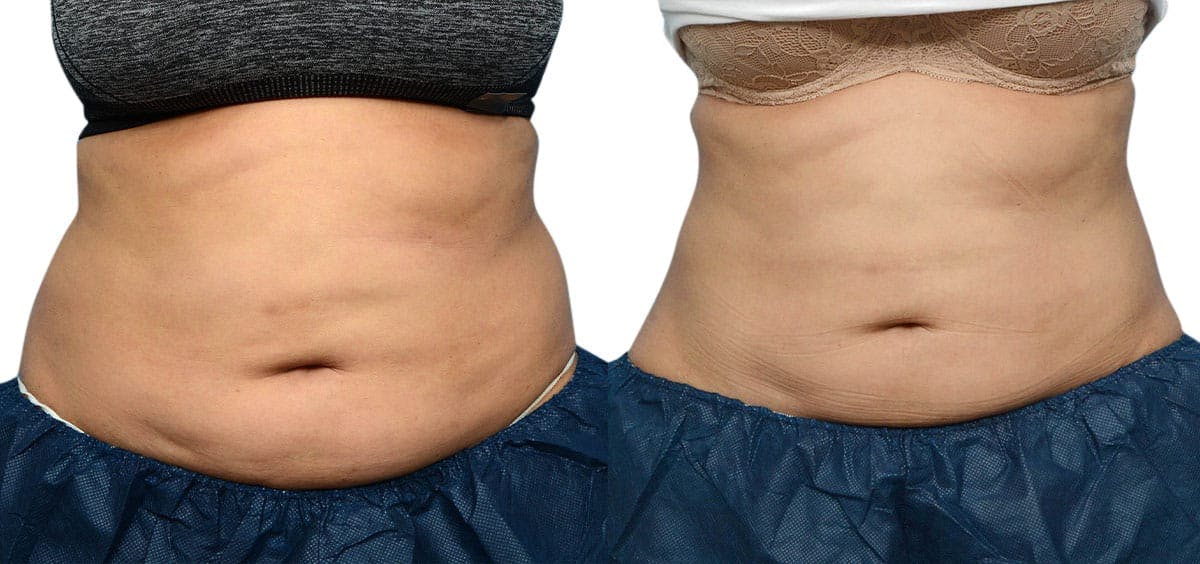 CoolSculpting® Before & After Gallery - Patient 393788 - Image 1