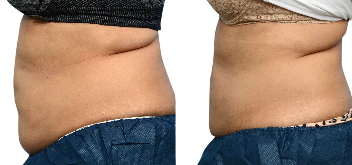 CoolSculpting® Before & After Gallery - Patient 393788 - Image 2