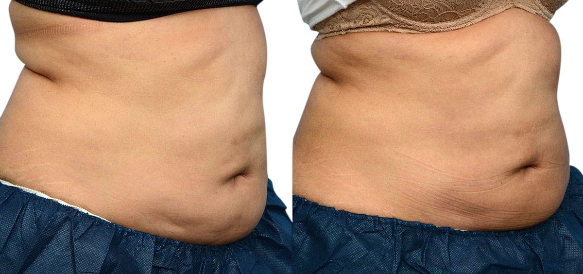 CoolSculpting® Before & After Gallery - Patient 393788 - Image 3