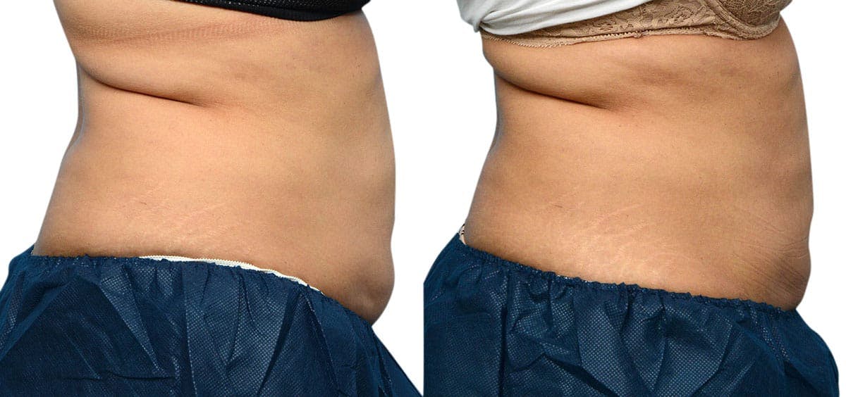 CoolSculpting® Before & After Gallery - Patient 393788 - Image 4