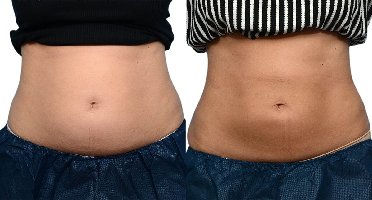 CoolSculpting® Before & After Gallery - Patient 721195 - Image 1