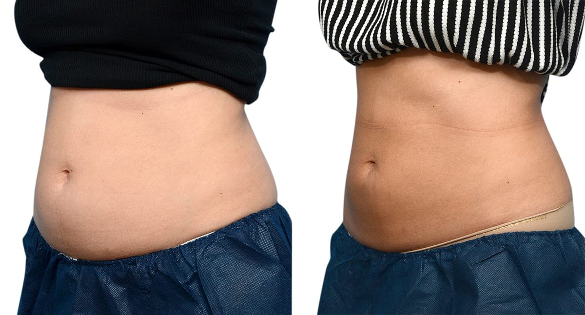 CoolSculpting® Before & After Gallery - Patient 721195 - Image 2