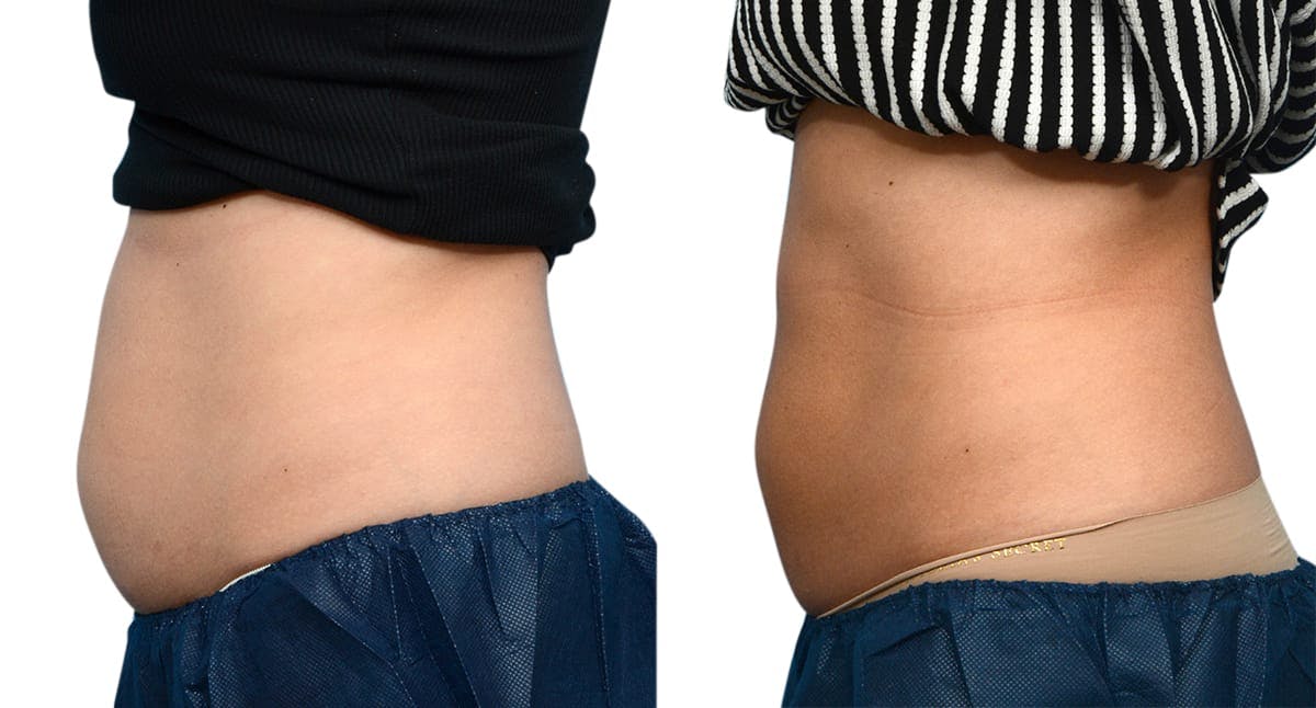 CoolSculpting® Before & After Gallery - Patient 721195 - Image 3