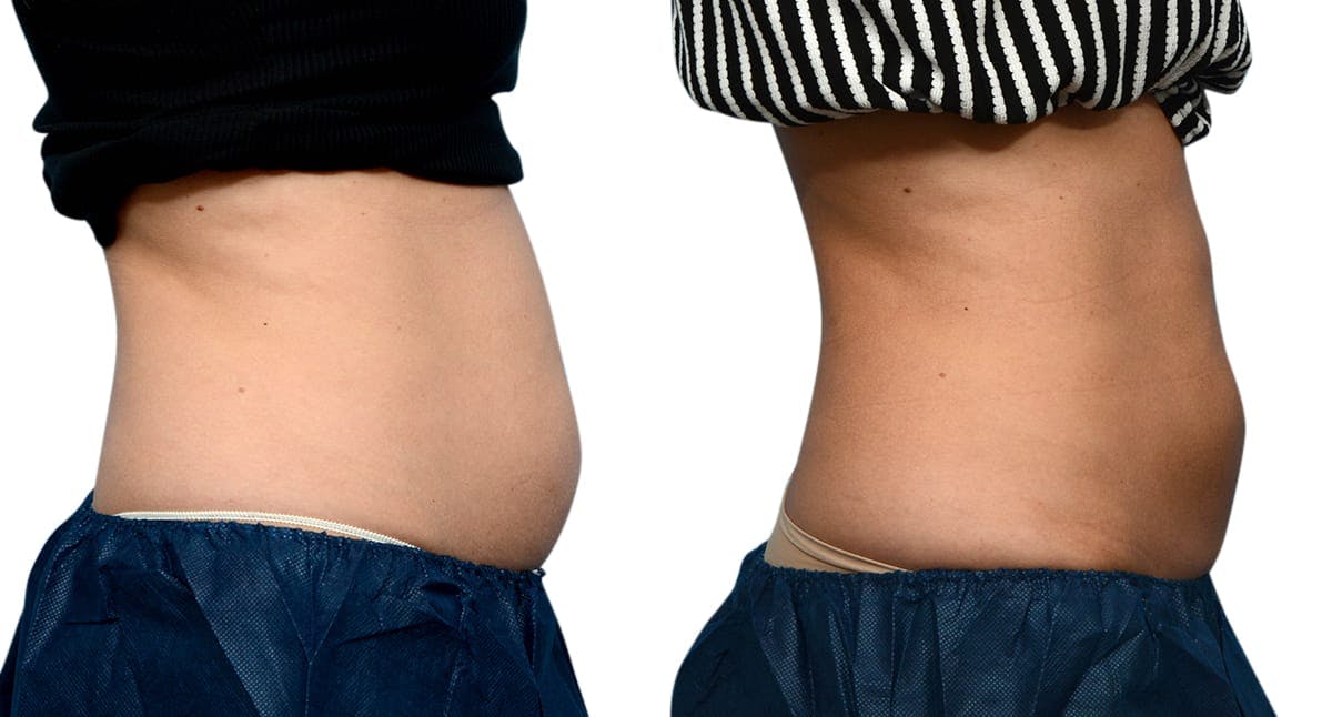 CoolSculpting® Before & After Gallery - Patient 721195 - Image 4