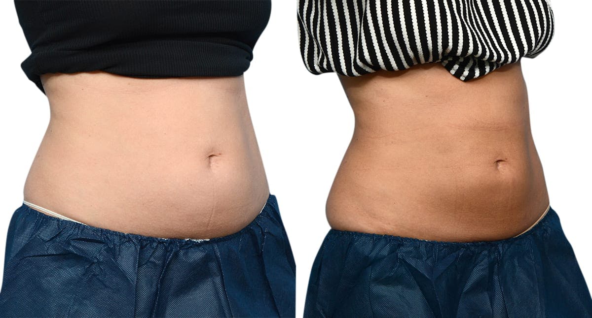 CoolSculpting® Before & After Gallery - Patient 721195 - Image 5