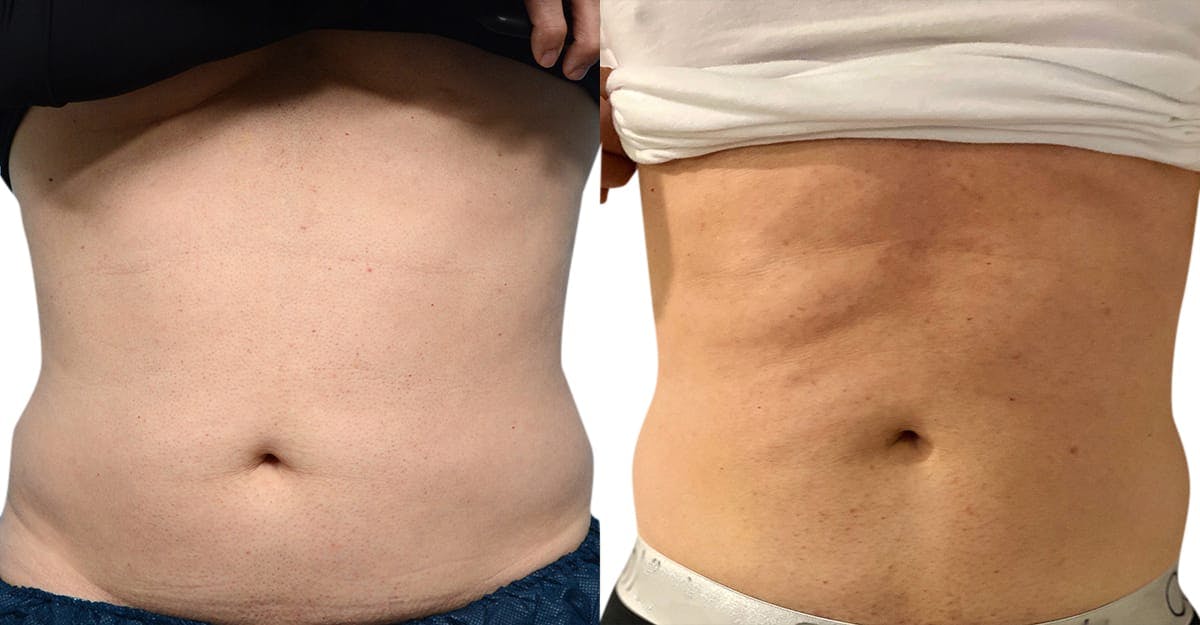 CoolSculpting® Before & After Gallery - Patient 322498 - Image 1