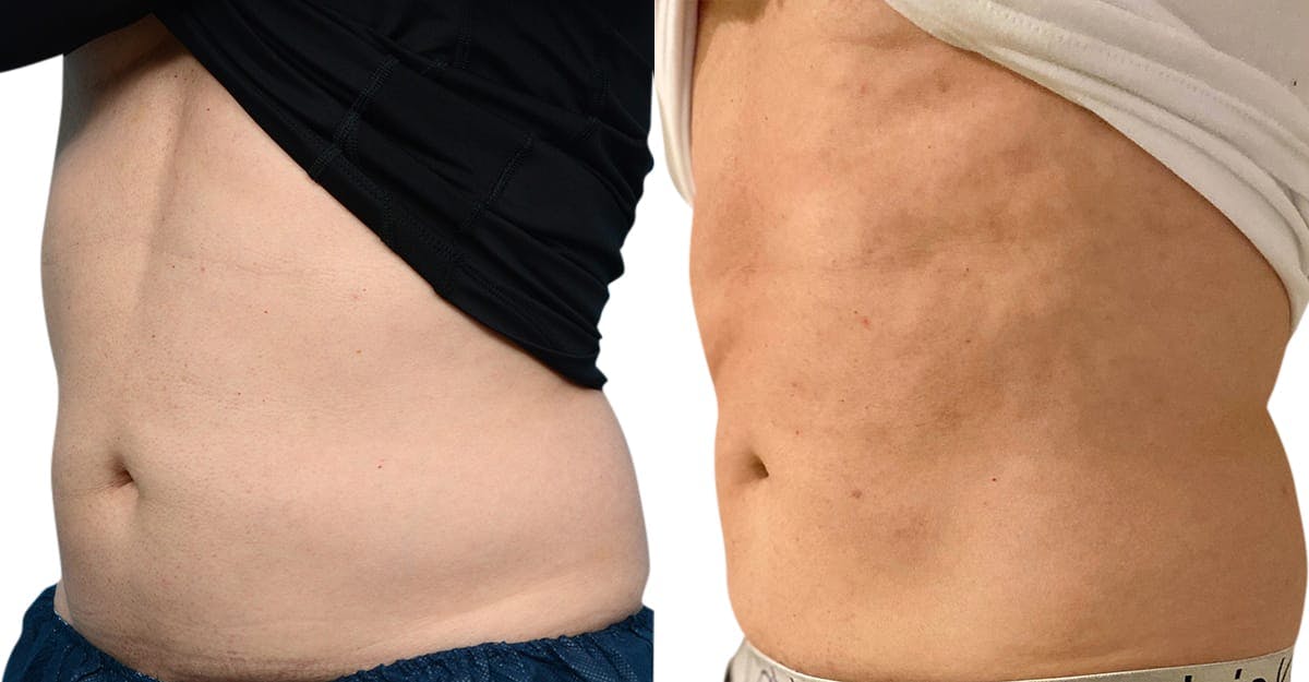 CoolSculpting® Before & After Gallery - Patient 322498 - Image 2