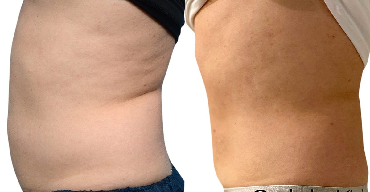 CoolSculpting® Before & After Gallery - Patient 322498 - Image 3