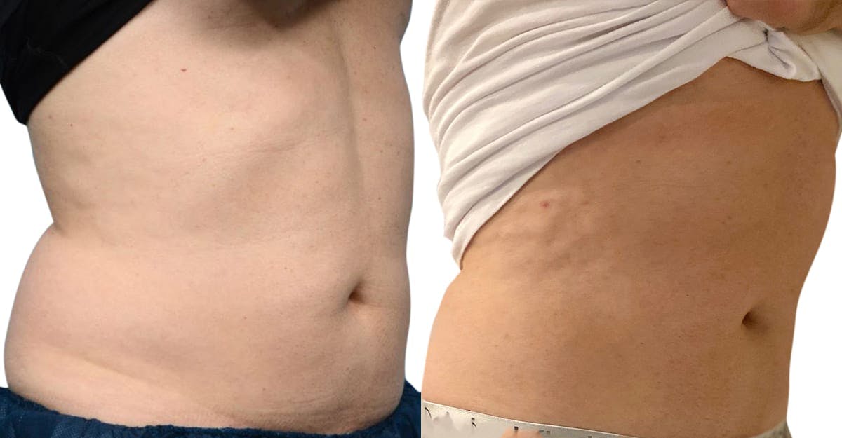 CoolSculpting® Before & After Gallery - Patient 322498 - Image 4