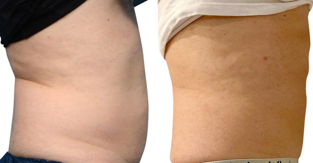 CoolSculpting® Before & After Gallery - Patient 322498 - Image 5