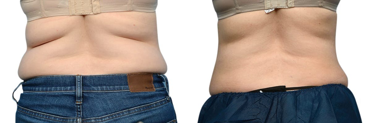CoolSculpting® Before & After Gallery - Patient 241882 - Image 1