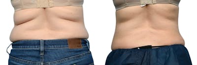 CoolSculpting® Before & After Gallery - Patient 241882 - Image 1