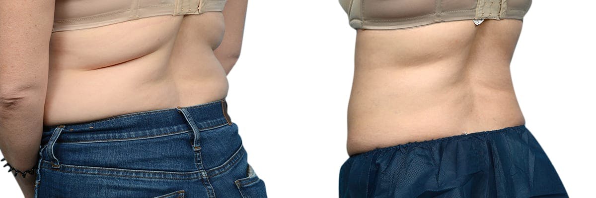 CoolSculpting® Before & After Gallery - Patient 241882 - Image 2