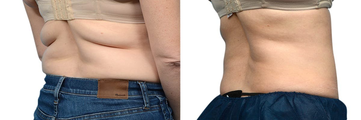 CoolSculpting® Before & After Gallery - Patient 241882 - Image 3