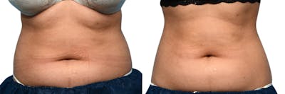 CoolSculpting® Before & After Gallery - Patient 308559 - Image 1