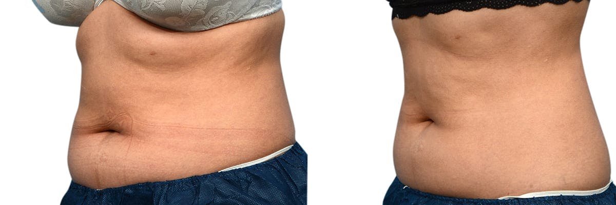 CoolSculpting® Before & After Gallery - Patient 308559 - Image 3