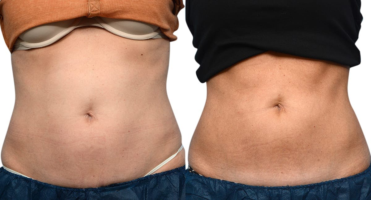 CoolSculpting® Before & After Gallery - Patient 279257 - Image 1