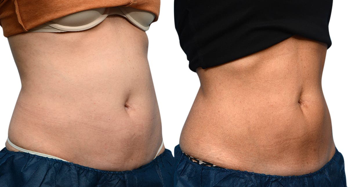 CoolSculpting® Before & After Gallery - Patient 279257 - Image 2
