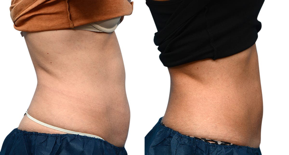CoolSculpting® Before & After Gallery - Patient 279257 - Image 3