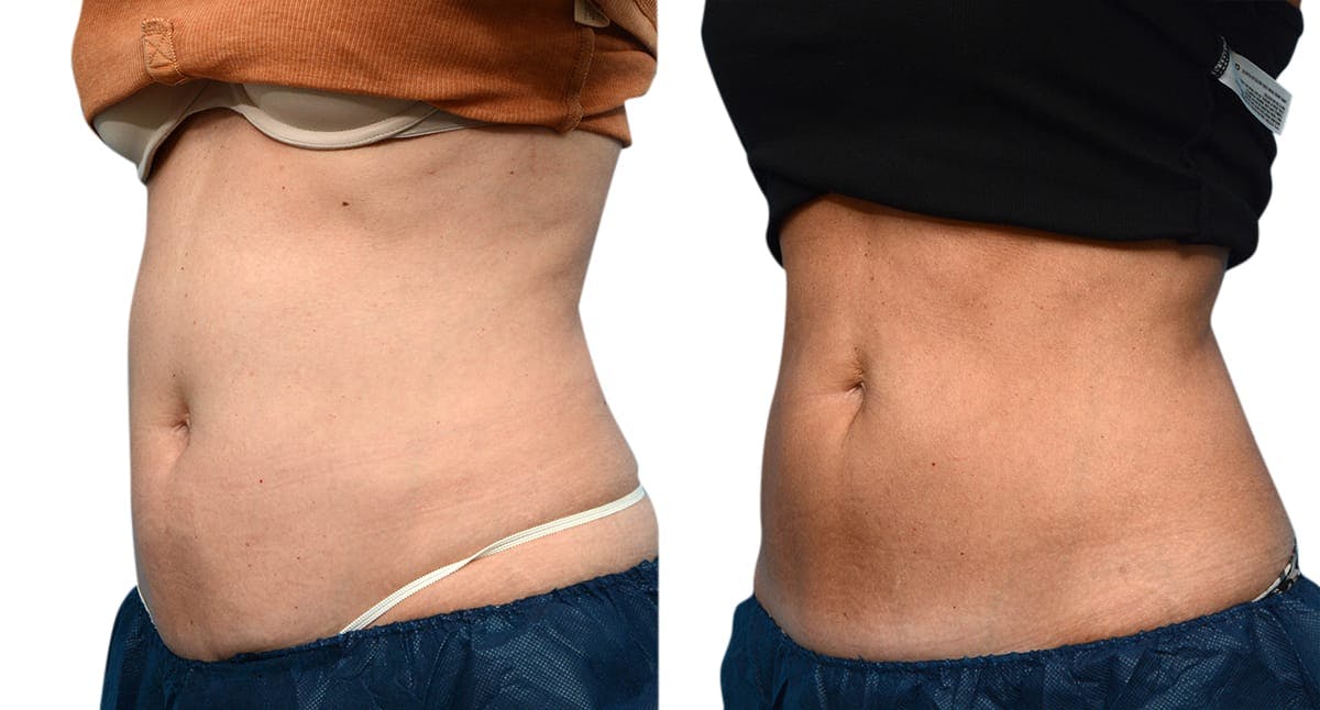 CoolSculpting® Before & After Gallery - Patient 279257 - Image 4