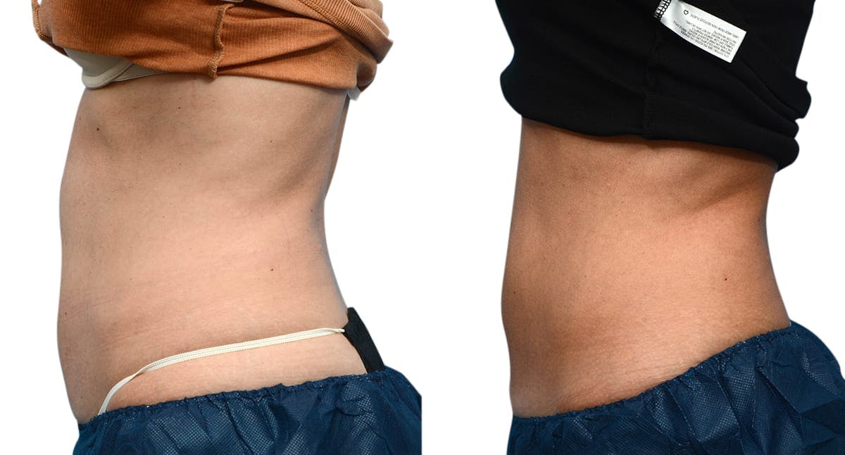 CoolSculpting® Before & After Gallery - Patient 279257 - Image 5