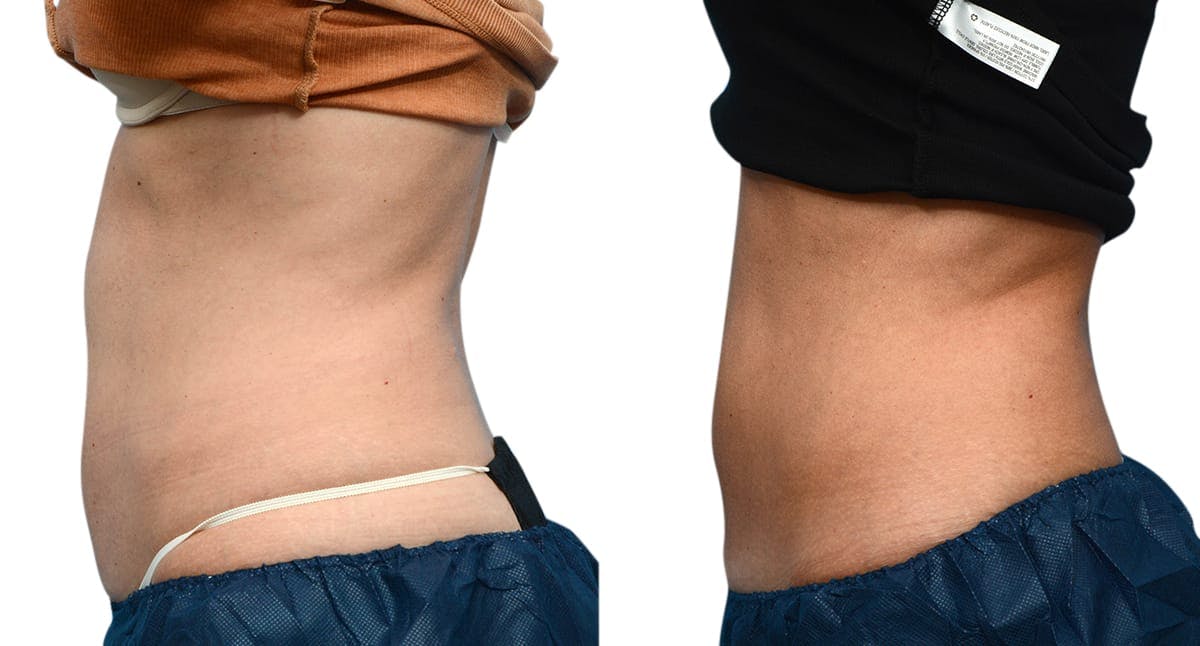 CoolSculpting® Before & After Gallery - Patient 279257 - Image 5