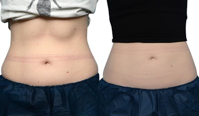 CoolSculpting® Before & After Gallery - Patient 224274 - Image 1