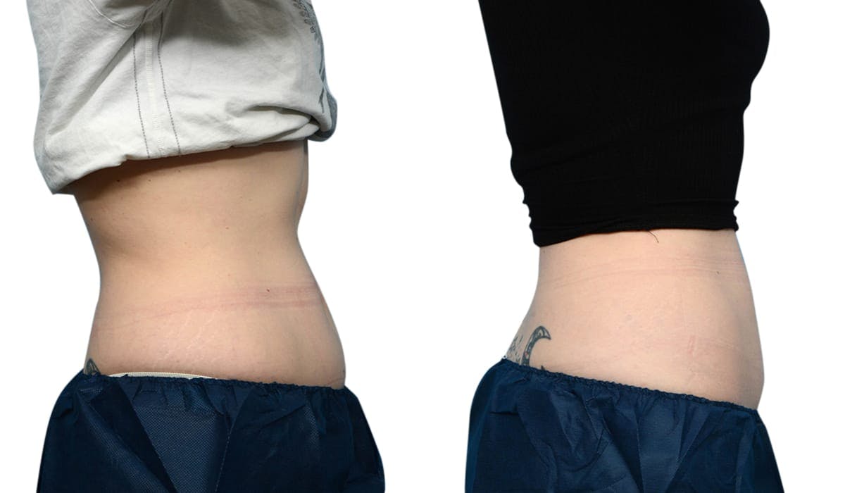 CoolSculpting® Before & After Gallery - Patient 224274 - Image 2