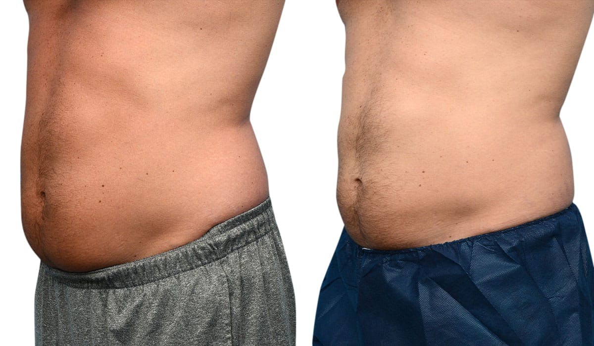 CoolSculpting® Before & After Gallery - Patient 274964 - Image 1