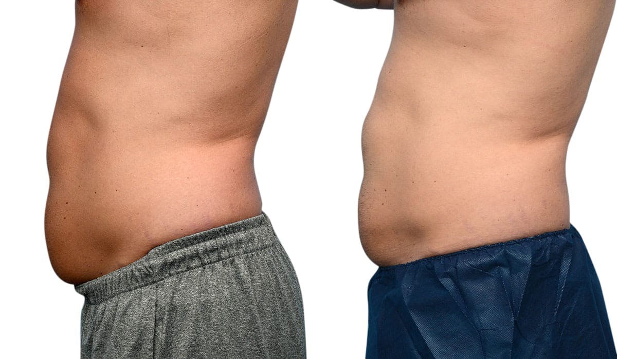 CoolSculpting® Before & After Gallery - Patient 274964 - Image 2