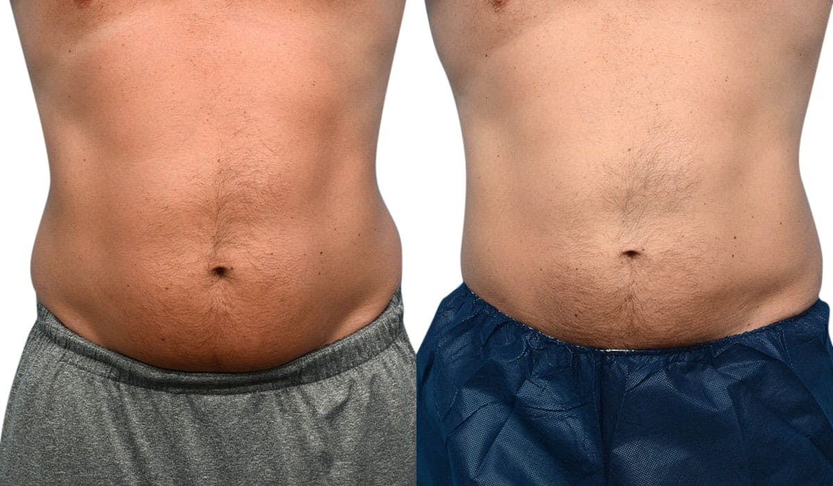 CoolSculpting® Before & After Gallery - Patient 274964 - Image 3
