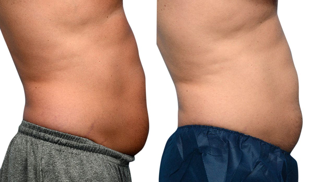 CoolSculpting® Before & After Gallery - Patient 274964 - Image 4