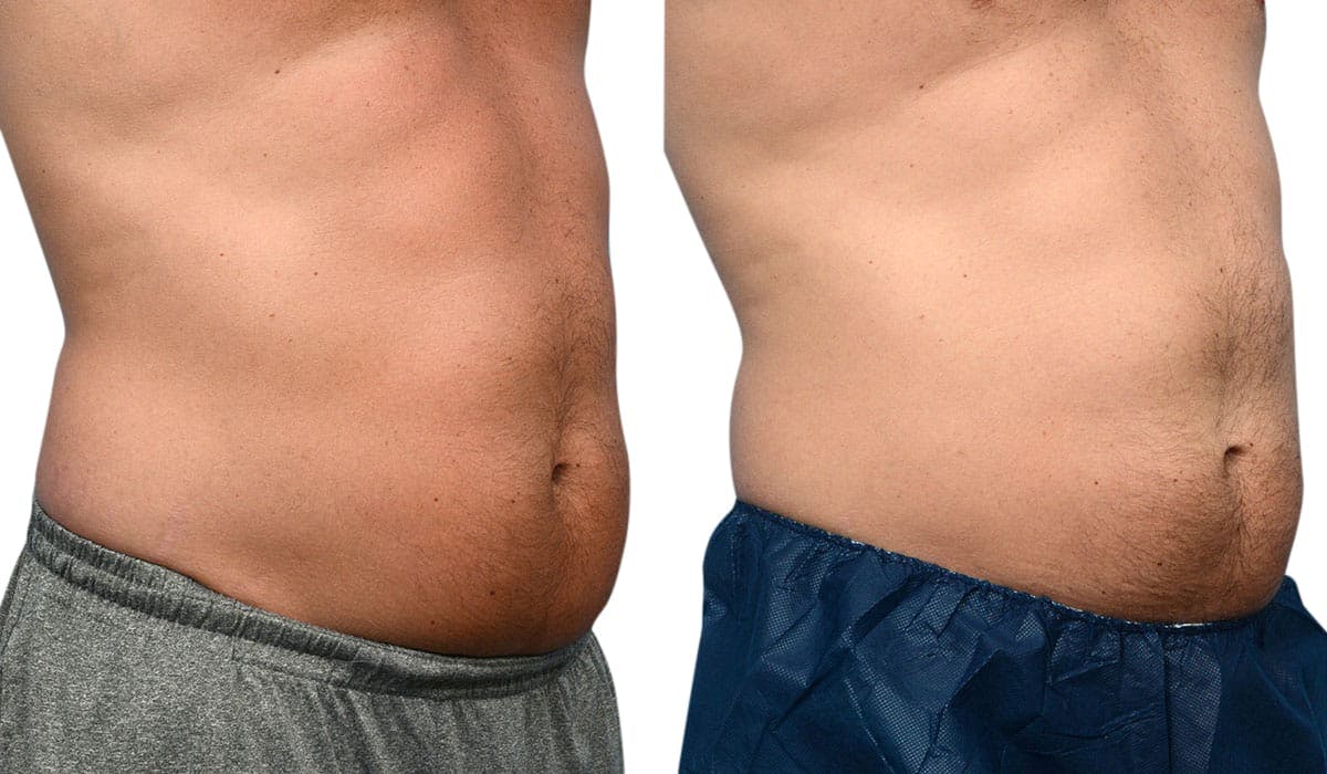 CoolSculpting® Before & After Gallery - Patient 274964 - Image 5