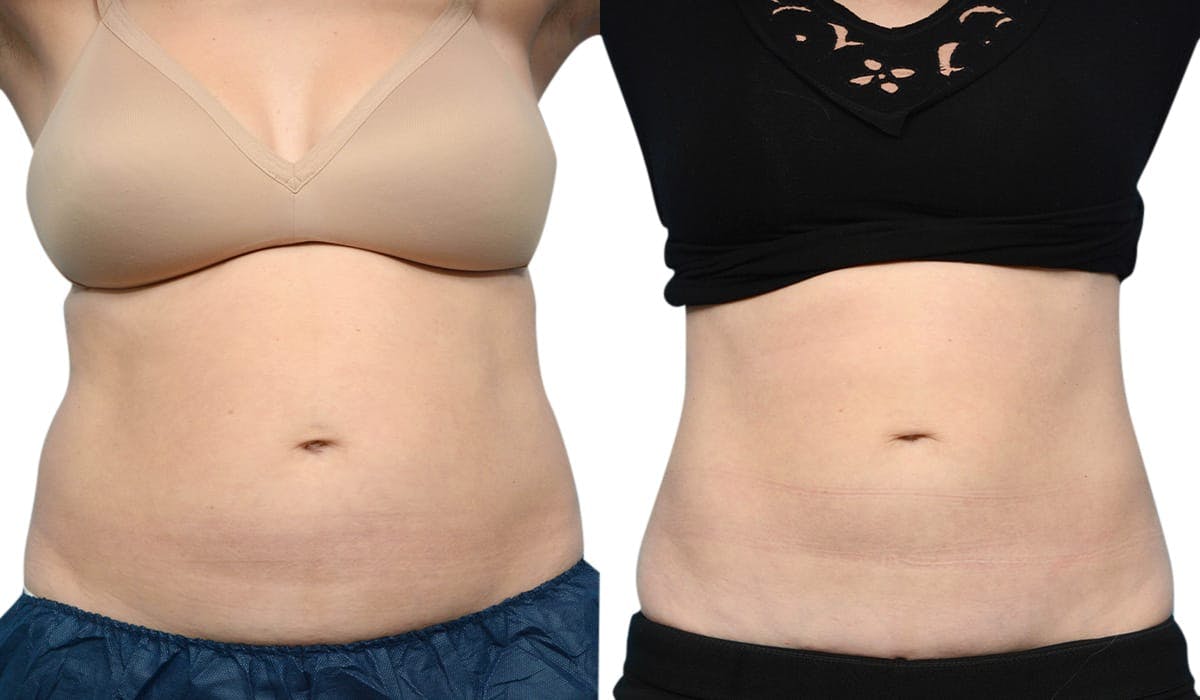 CoolSculpting® Before & After Gallery - Patient 412565 - Image 1