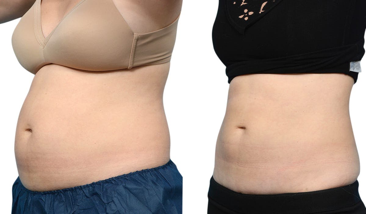 CoolSculpting® Before & After Gallery - Patient 412565 - Image 2