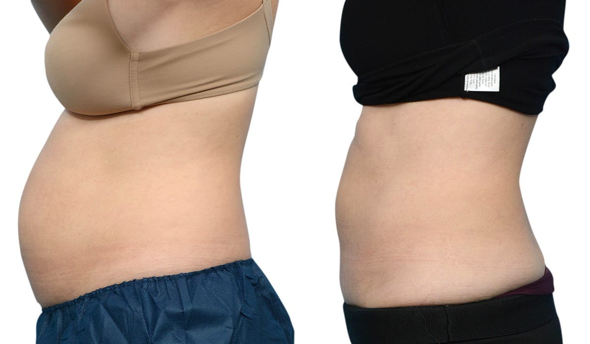 CoolSculpting® Before & After Gallery - Patient 412565 - Image 3