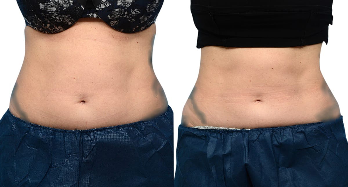 CoolSculpting® Before & After Gallery - Patient 367528 - Image 1