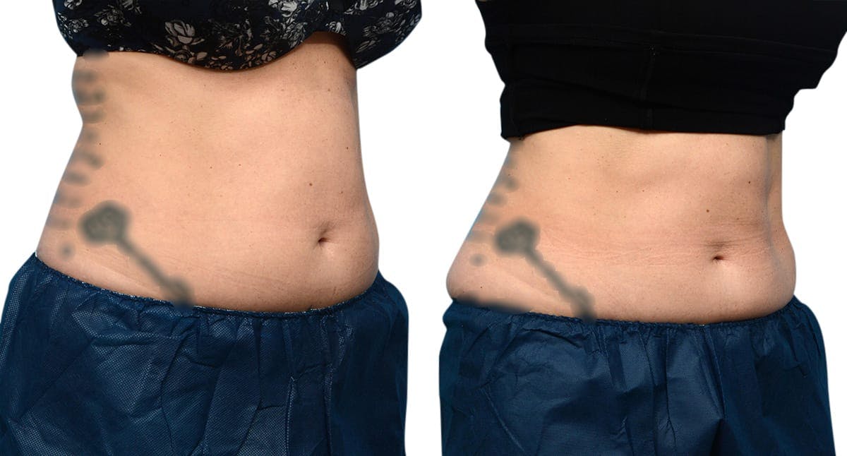 CoolSculpting® Before & After Gallery - Patient 367528 - Image 2