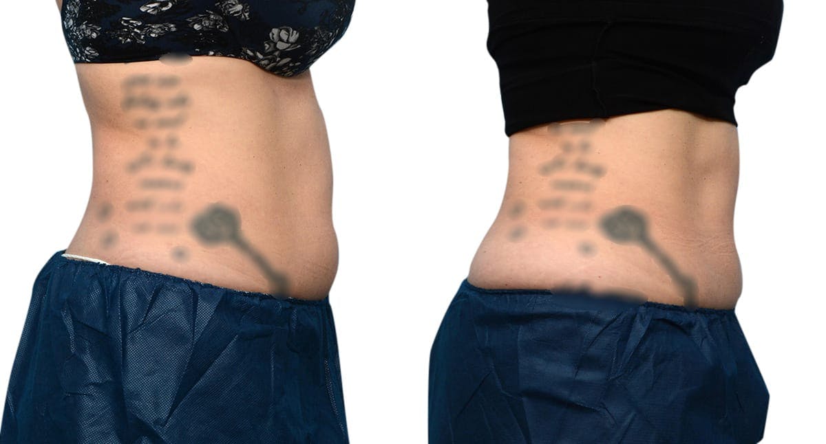 CoolSculpting® Before & After Gallery - Patient 367528 - Image 3