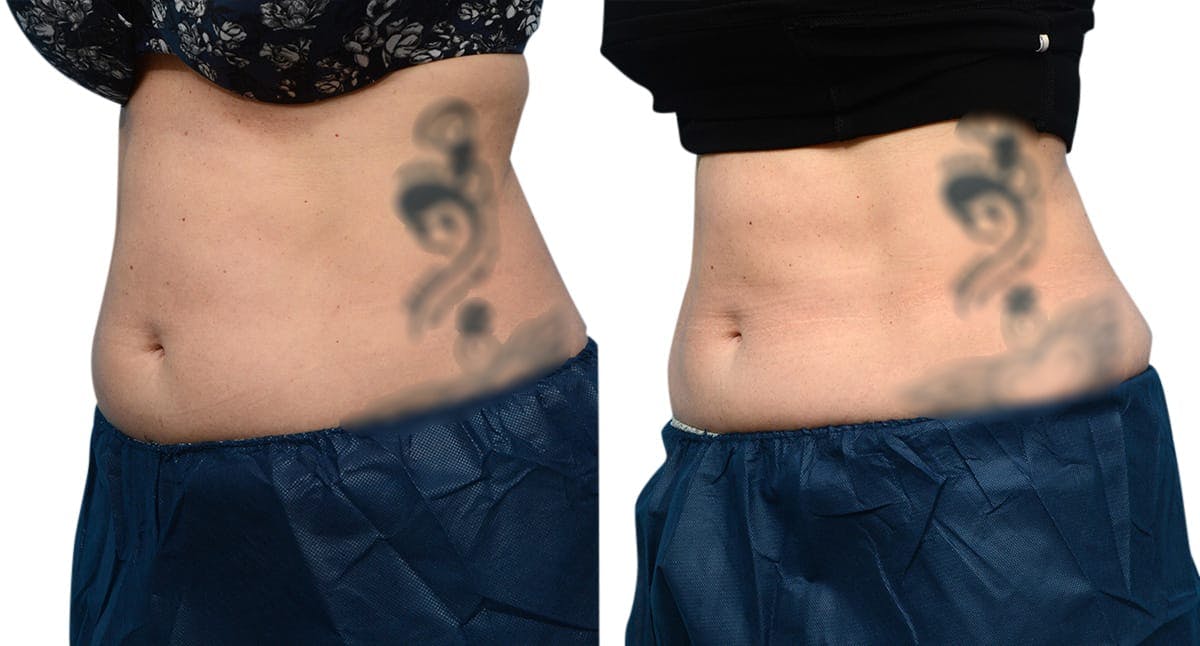 CoolSculpting® Before & After Gallery - Patient 367528 - Image 4