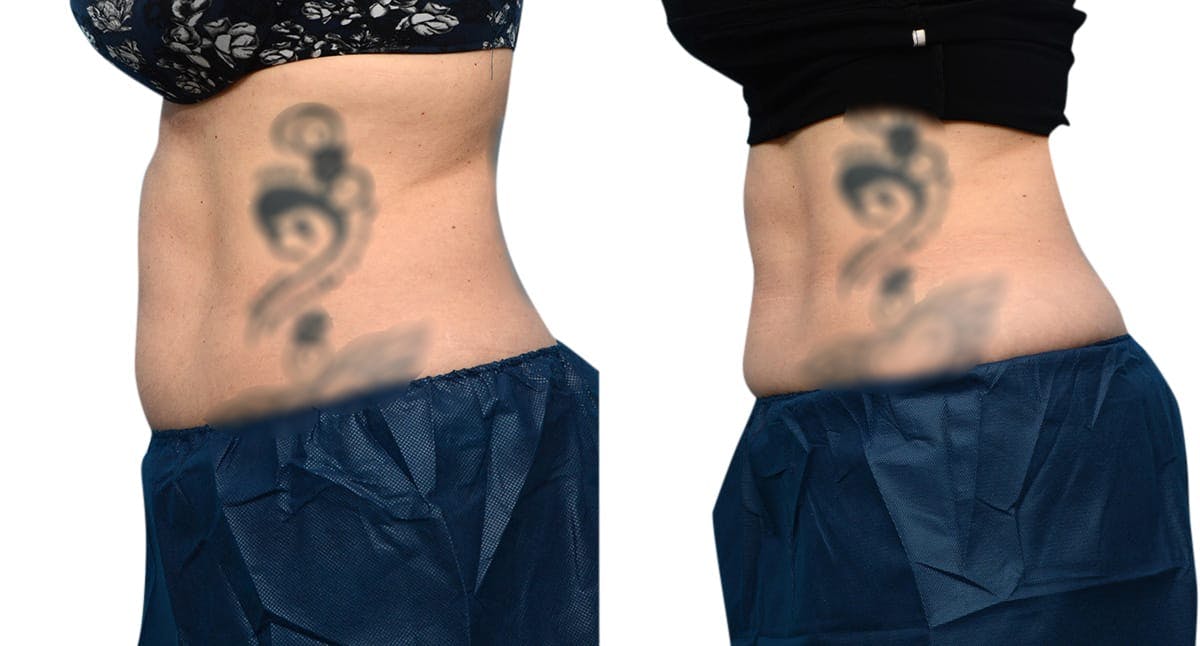 CoolSculpting® Before & After Gallery - Patient 367528 - Image 5